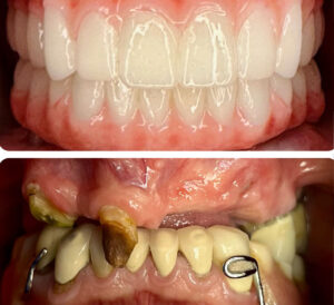 Monterey Dental Implant Center Before & After