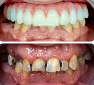Monterey Dental Implant Center Before & After