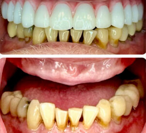 Monterey Dental Implant Center Before & After