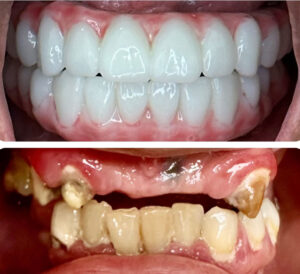 Monterey Dental Implant Center Before & After
