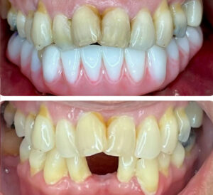 Monterey Dental Implant Center Before & After