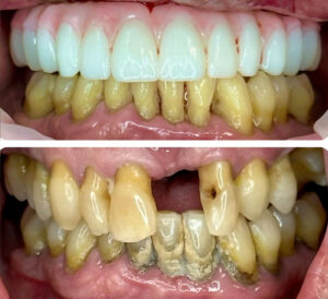 Monterey Dental Implant Center Before & After