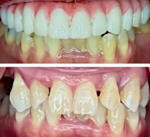 Monterey Dental Implant Center Before & After