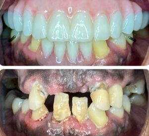 Monterey Dental Implant Center Before & After