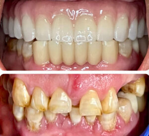Monterey Dental Implant Center Before & After